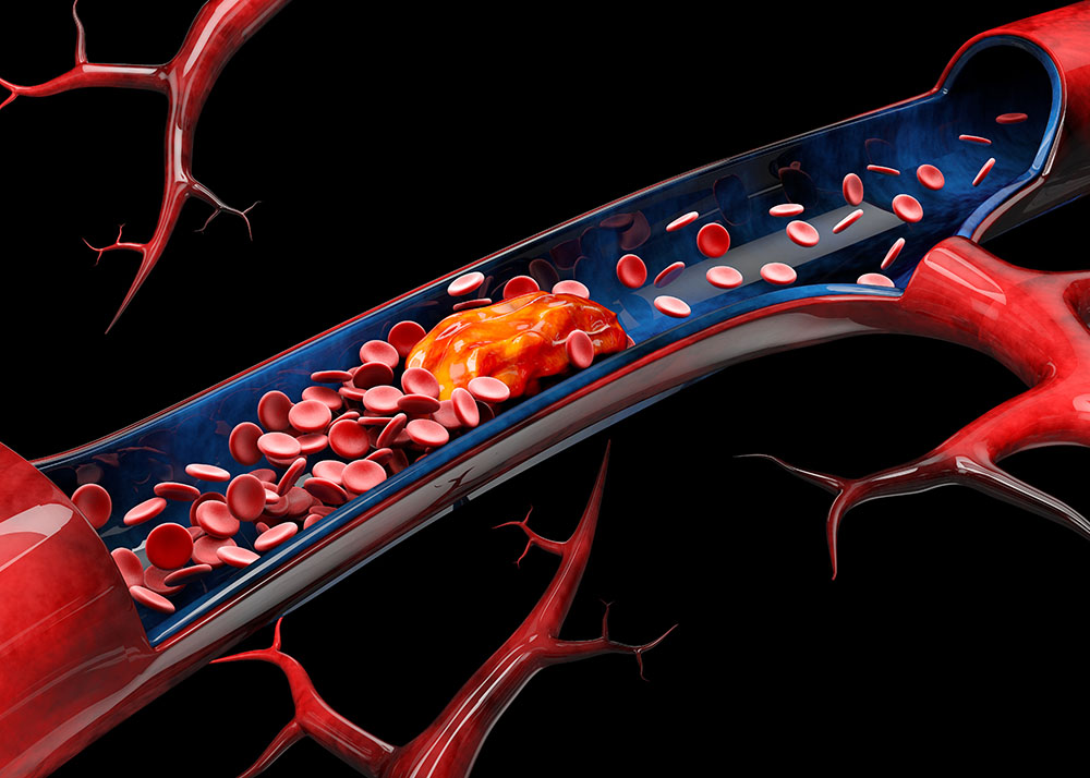 3dIllustration of cerebral sclerosis isolated black background.