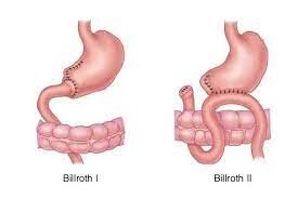 Billroth I und II / tbd Billroth I und II