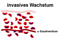 Die Abbildung zeigt ein invasives Wachstum und die Basalmembran