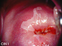 Das Foto zeigt CIN I - leichteste Form der Zellveränderungen, die sich meist von selbst zurückbildet