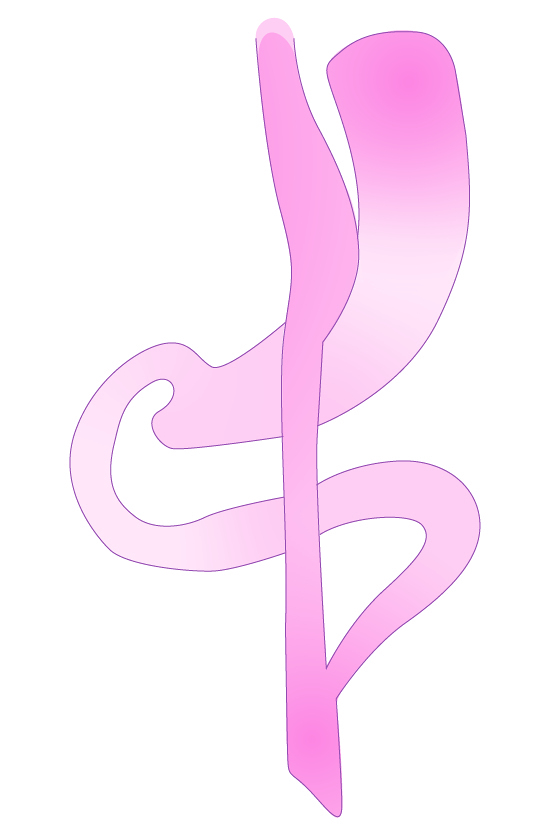 Y-Roux Magenbypass / Barmherzige Brüder Graz Y-Roux Magenbypass