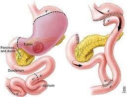 Tumorabsiedelungen / tbd Tumorabsiedelungen