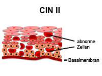 Die Abbildung zeigt CIN II mit abnormen Zellen und Basalmembran