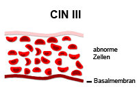 Die Abbildung zeigt CIN III mit abnormen Zellen und Basalmembran
