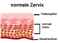 Die Abbildung zeigt normale Zervix mit Plattenepithel, normale Zellen und Basalmembran