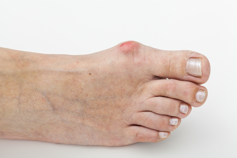 Closeup of a bunion, hallux on foot