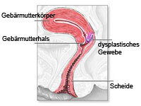 Die Abbildung zeigt Gebärmutterkörper, Gebärmutterhals, dysplastisches Gewebe, Scheide