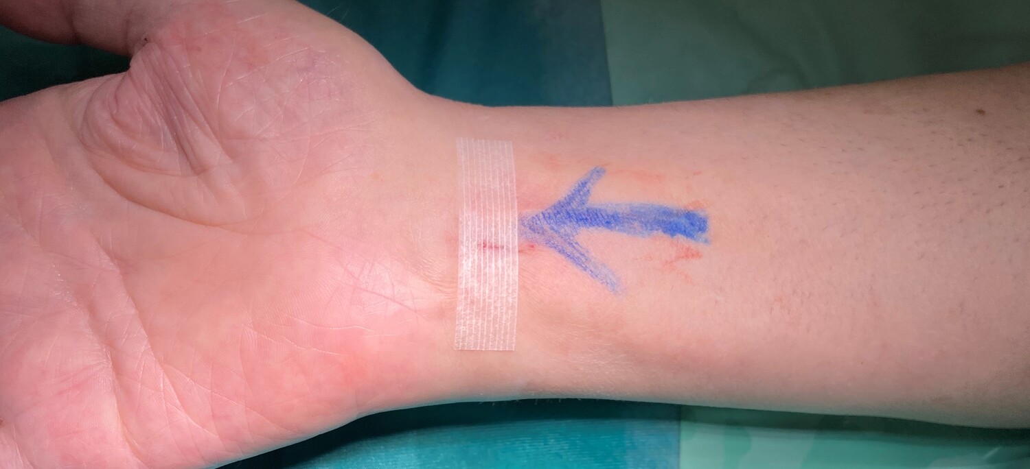 KARPALTUNNELSYNDROM / Barmherzige Brüder Graz KARPALTUNNELSYNDROM