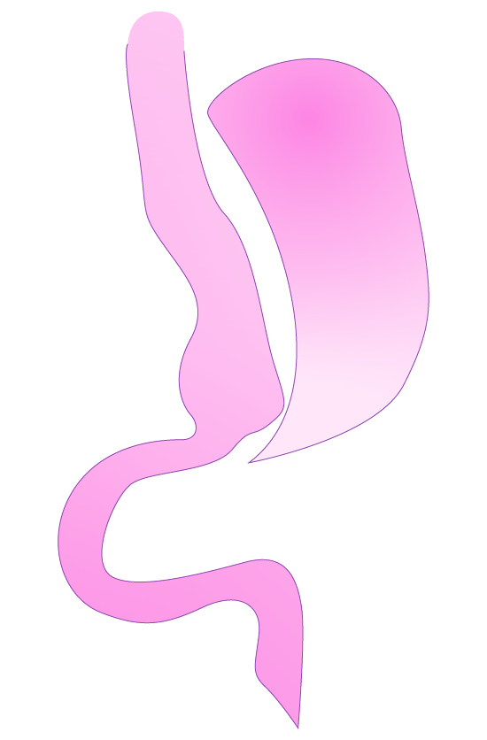 Schlauchmagen / Barmherzige Brüder Graz Schlauchmagen