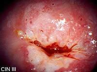 Das Foto zeigt  CIN III - am weitest fortgeschrittene Vorstufe; die Rückbildungstendenz bei der CIN III ist wesentlich geringer und beträgt ungefähr 30%, meist wird eine CIN III mittels einer Schlingenresektion chirurgisch entfernt.