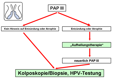 Das Bild zeigt die Schritte von einem PAP III Abstrich bishin zur Kolposkopie/Biopsie, HPV-Testung