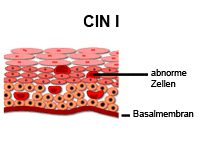 Die Abbildung zeigt CIN I mit abnormen Zellen und Basalmembran